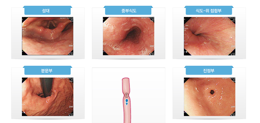 정상식도, 위, 십이지장 사진