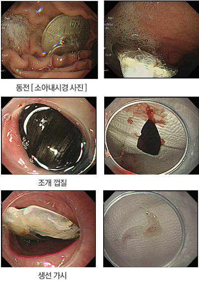 내시경적 이물제거술